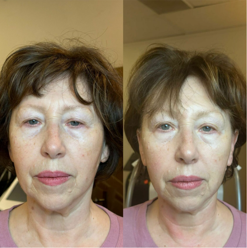 woman's face before and after