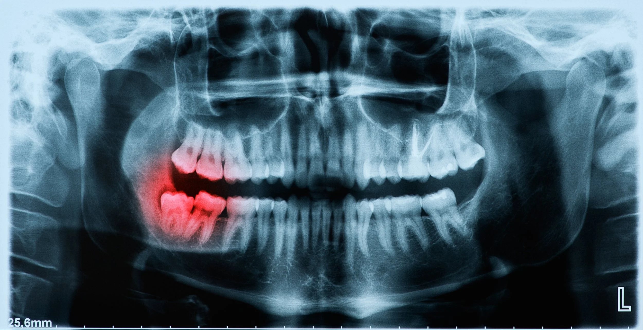 Dr. Jongwoo Joseph Park, dentist at Smile Care – SC Dental Group, is an expert in wisdom teeth extraction