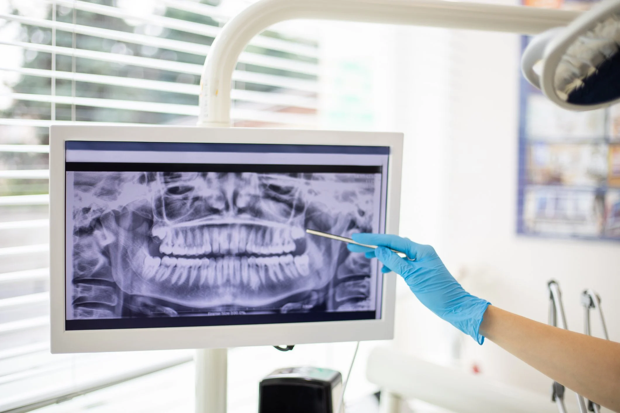 we are expert in wisdom teeth extractions