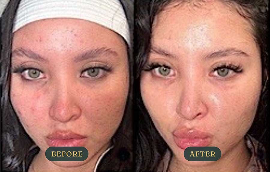 the-perfect-derma-peel.jpg
