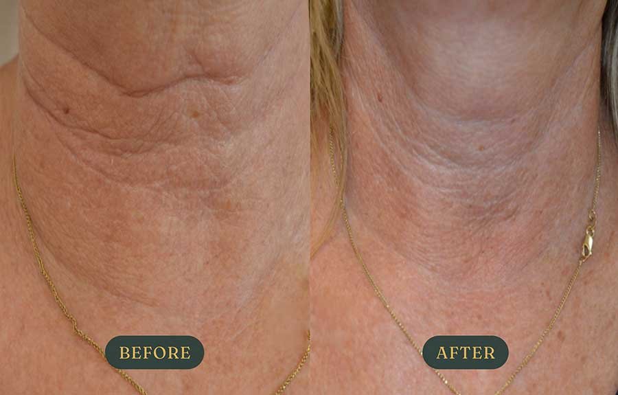 tixel-neck-skin-rejuvenation-service-redding.jpg