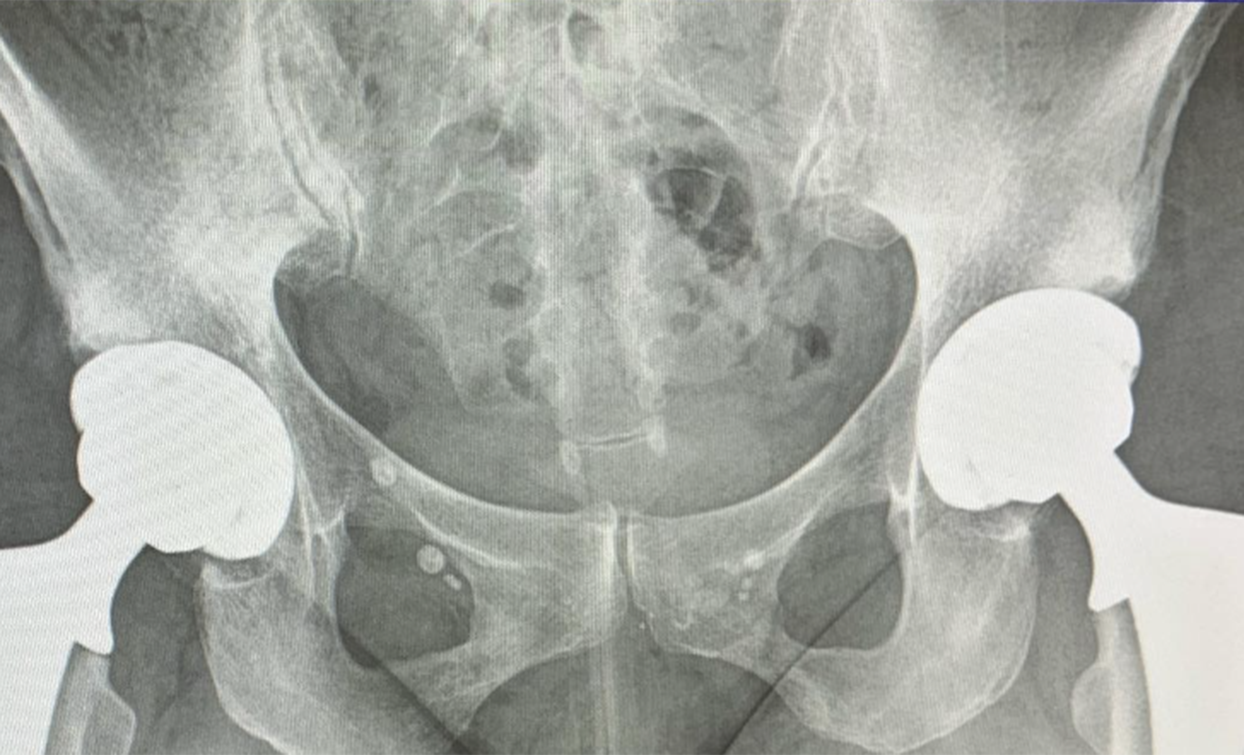 Four Years Stronger: My Hip Replacement Surgery Anniversary
