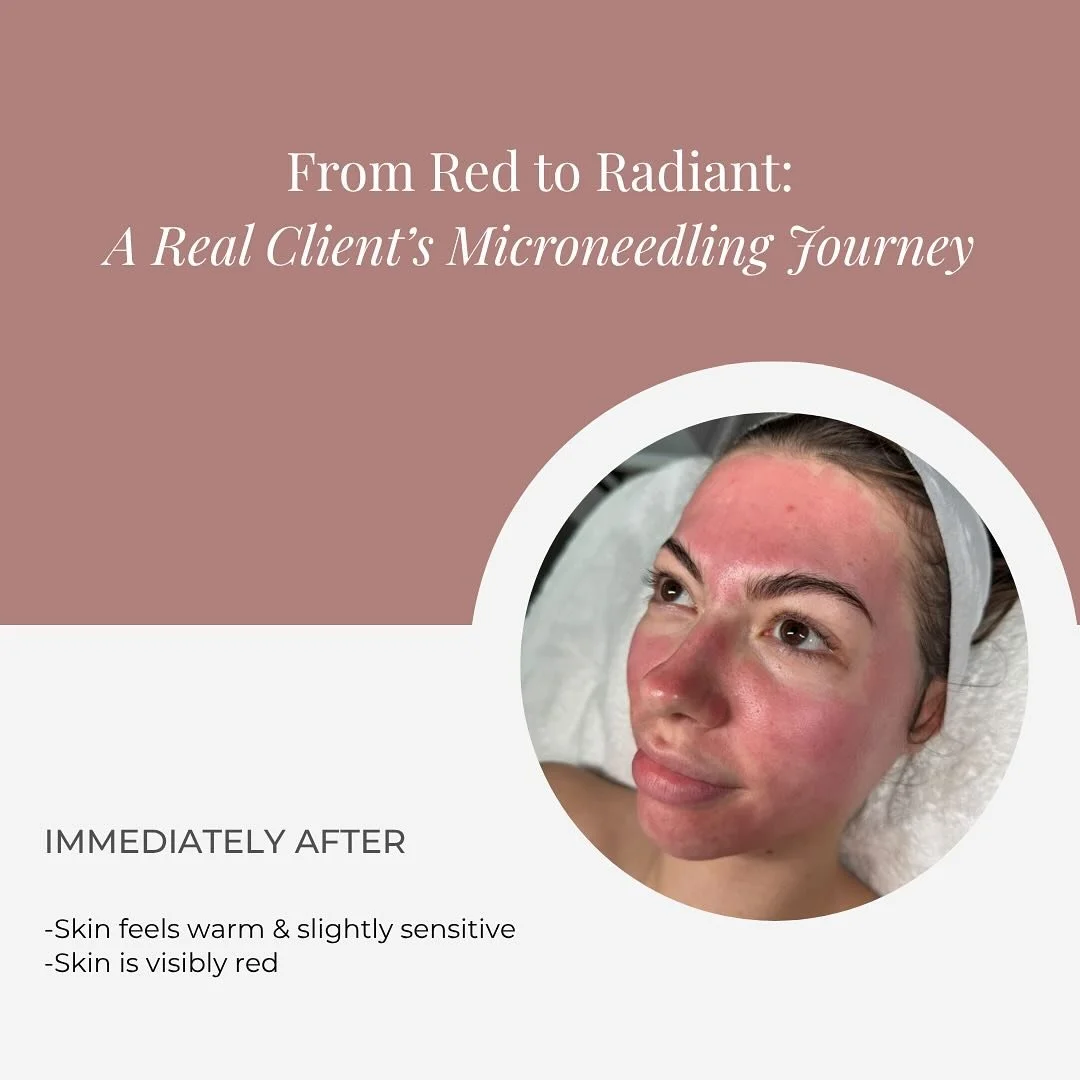 &ldquo;Is microneedling worth it?&rdquo; Here&rsquo;s an unfiltered look at the healing journey&hellip; 👇

If you&rsquo;ve ever thought:
🔸 &ldquo;Will I be red for days?&rdquo;
🔸 &ldquo;What will my skin feel like?&rdquo;
🔸 &ldquo;How long until 