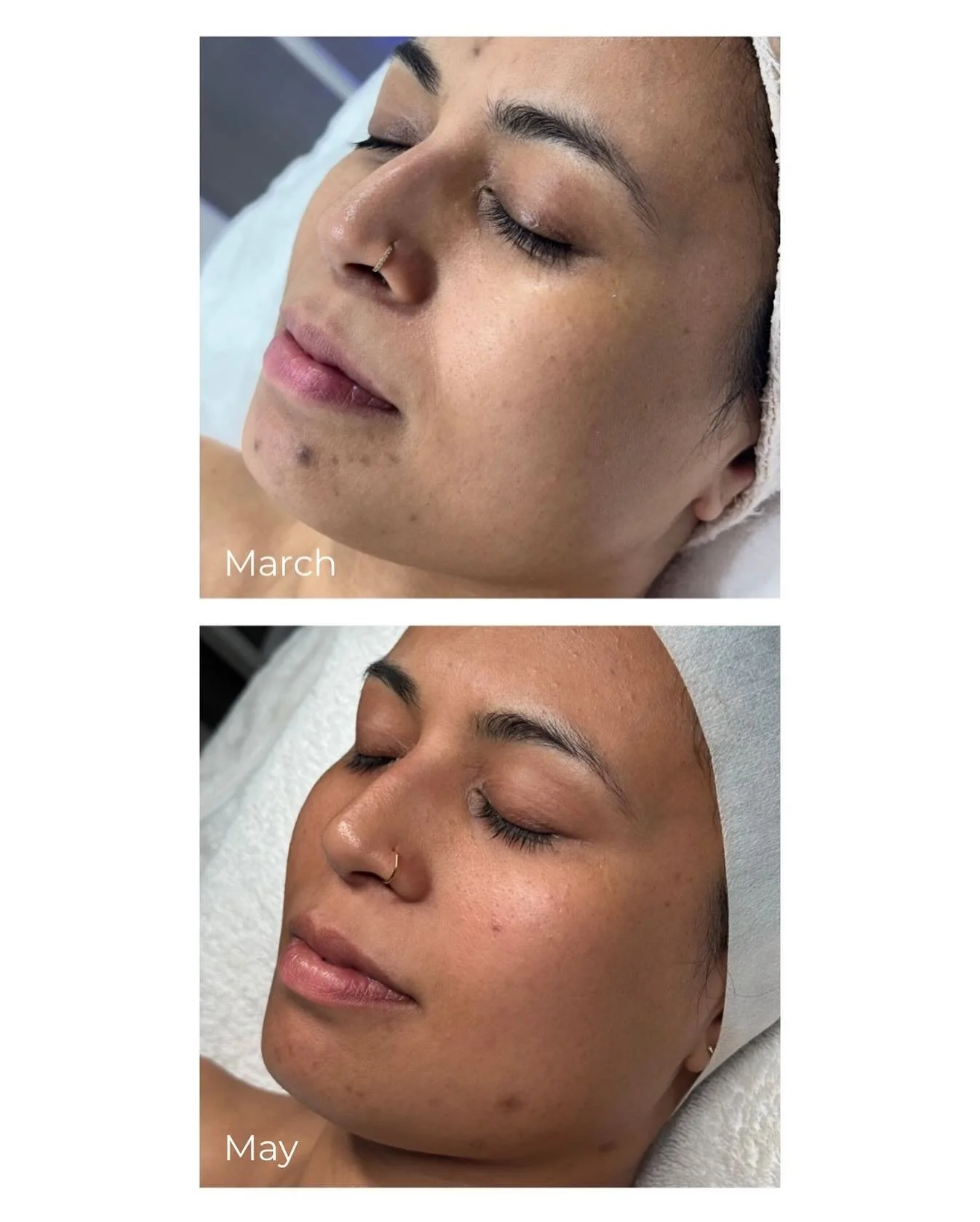 Real skin. Real results. ✨

This client committed to deep, skin-loving care over 2 months using a combination of:
💧 Seventy Hyal skin boosters &ndash; to restore hydration and glow from within
🌿 Medik8 Even Peel treatments &ndash; to refine tone, t