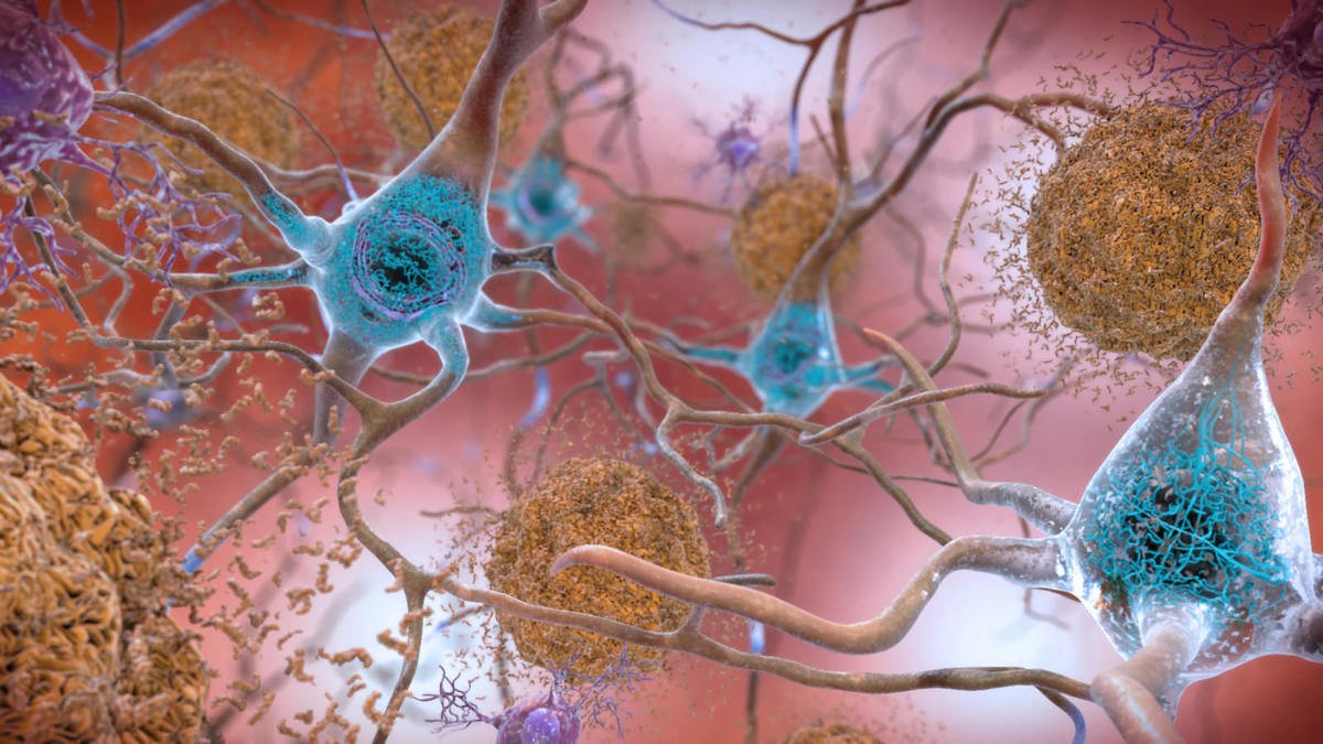 Alzheimer’s Disease: Molecular Mechanisms, Clinical Manifestations, and Treatments