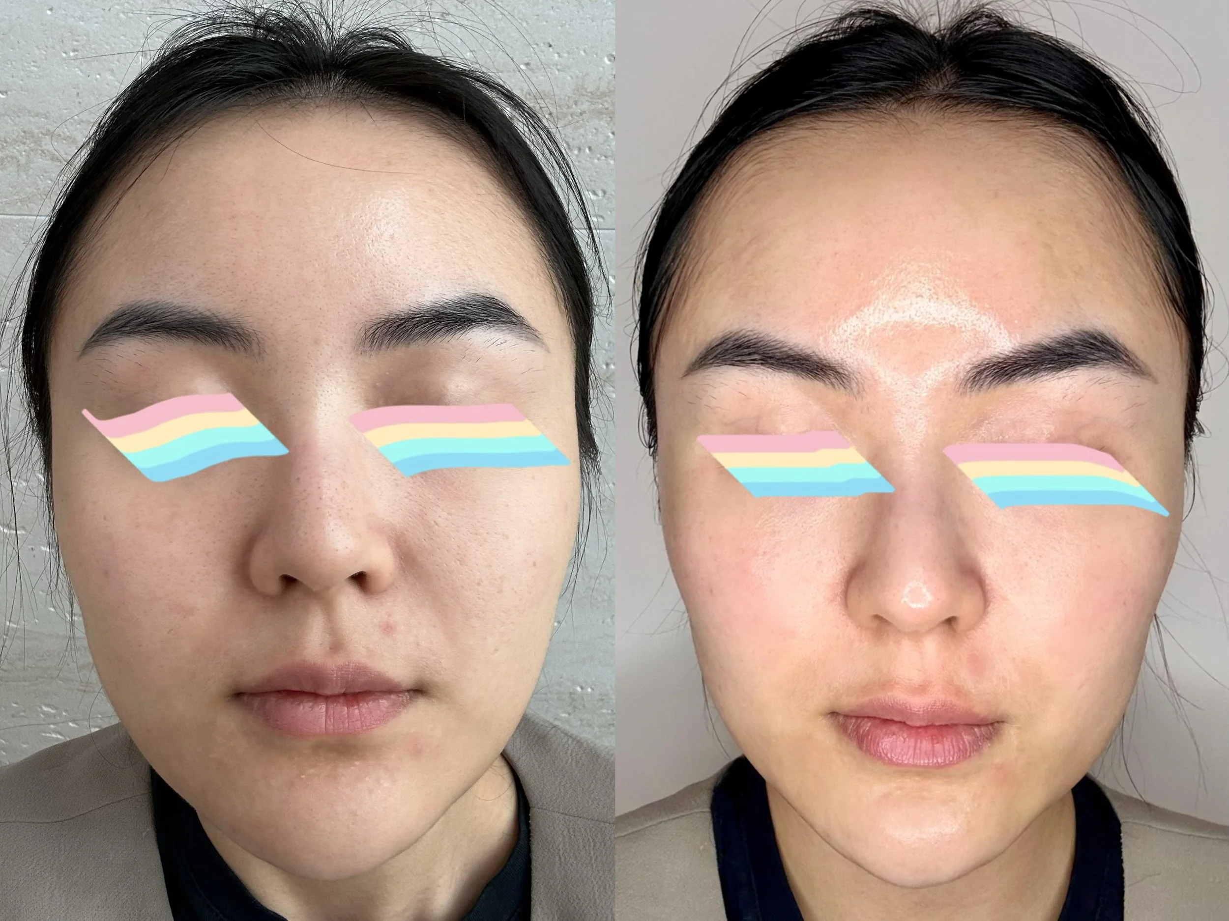 Before after Bright & Glow Peel Facial