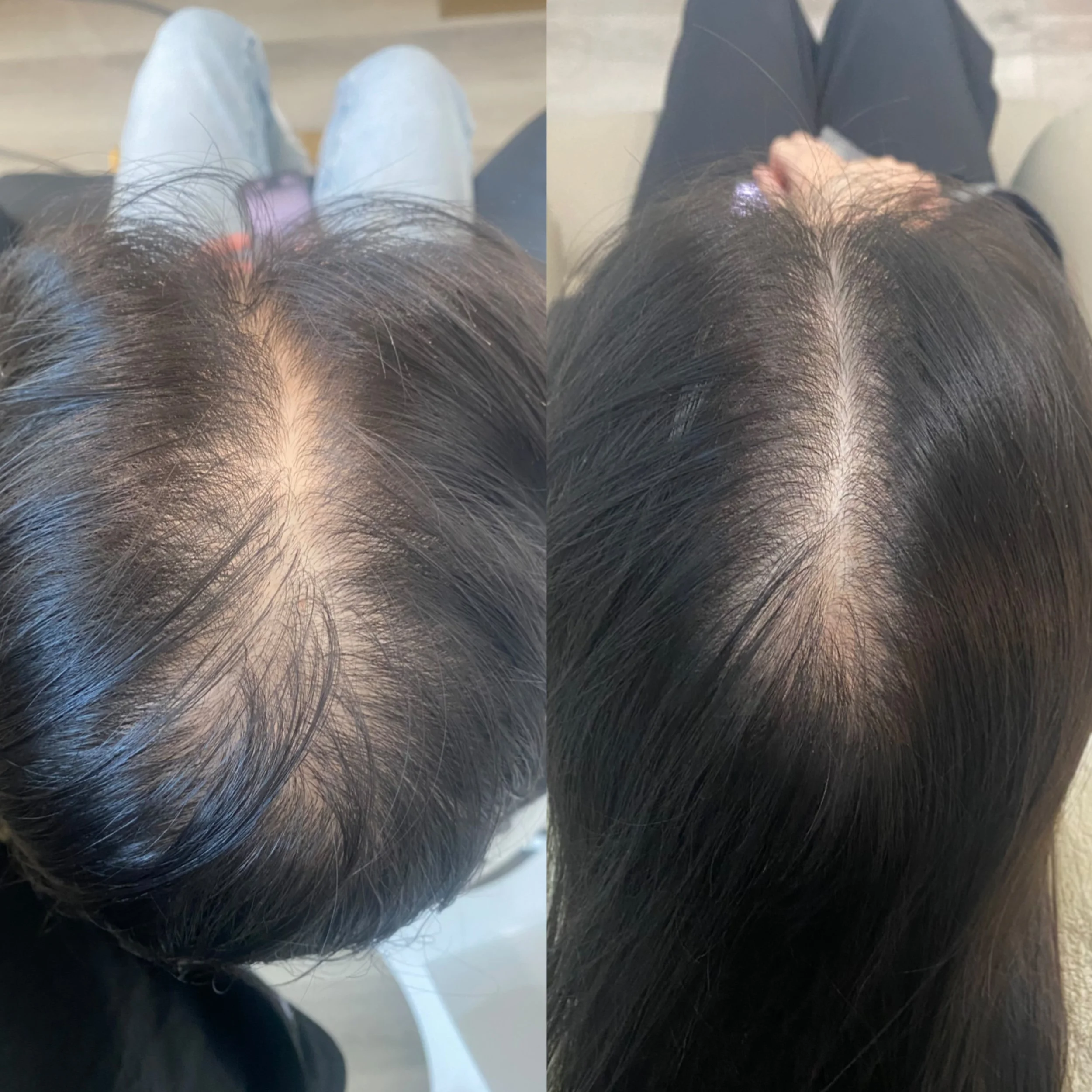 Before after Hair growth bellanova