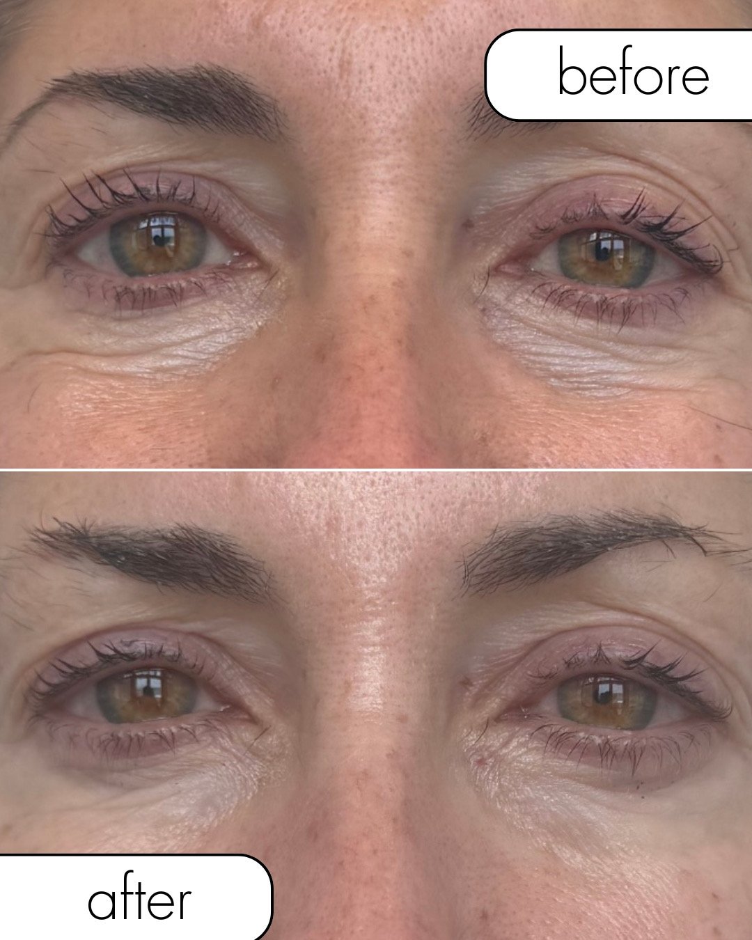 Before after Eye Treatment