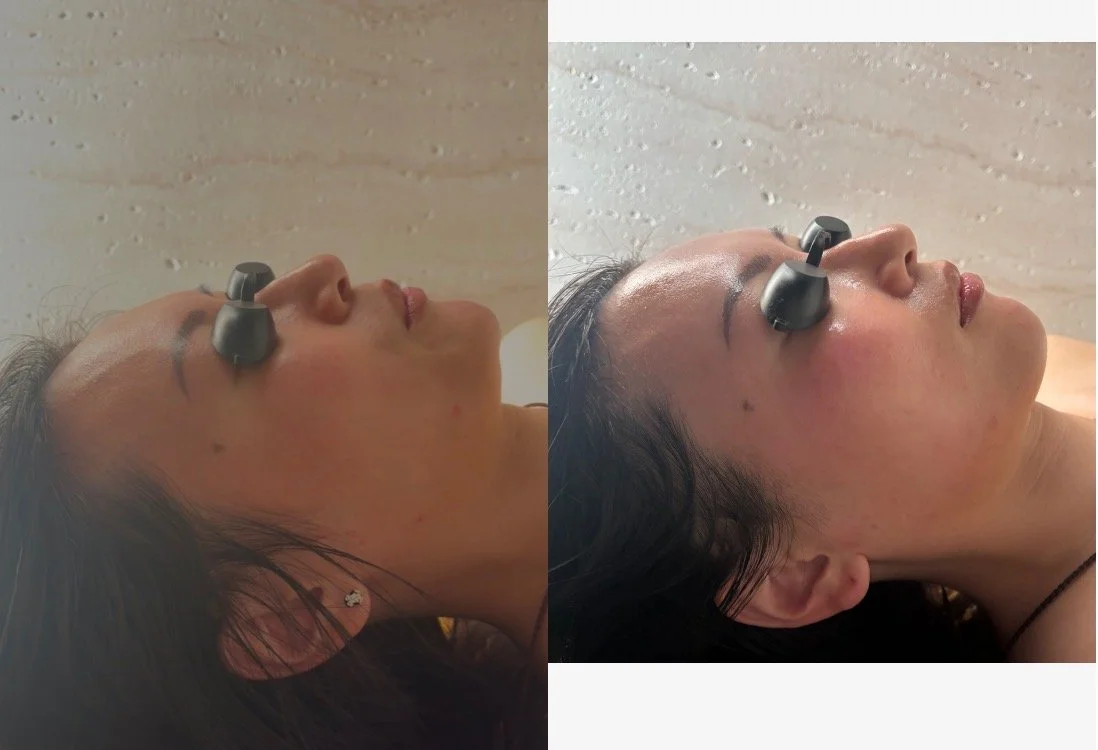 Before After Bellanova Face Sculpting Facial