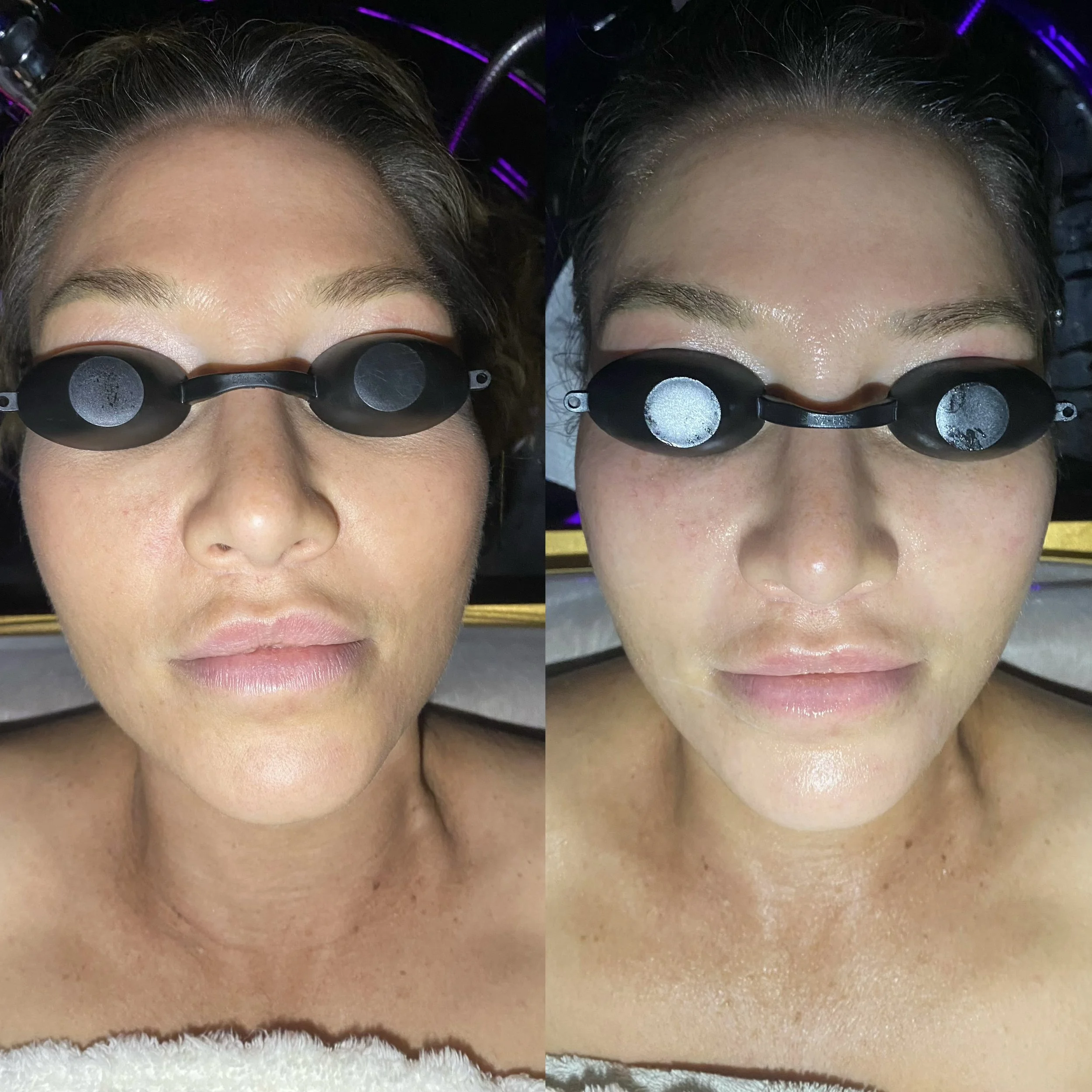 Before after Bellanova Face Sculpting Facial