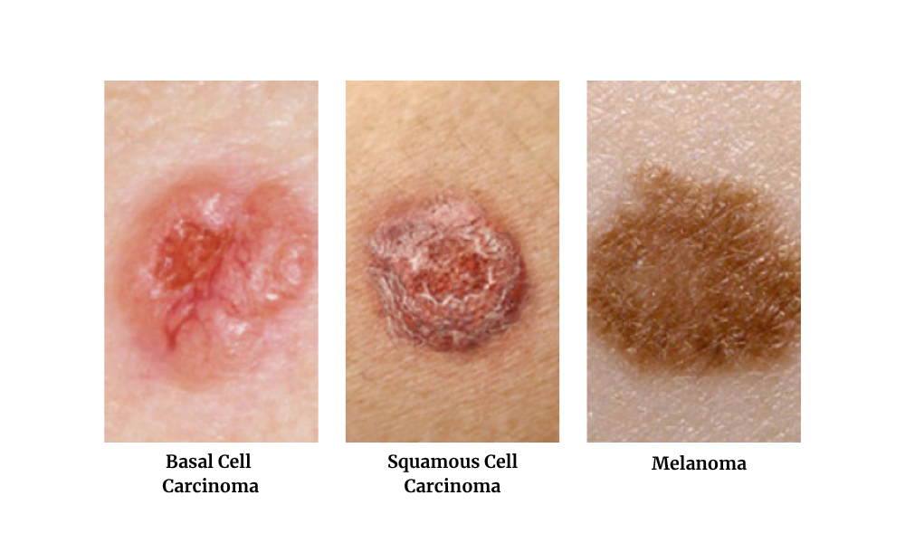 How to identify three types of skin cancer: BCC, SCC, and melanoma