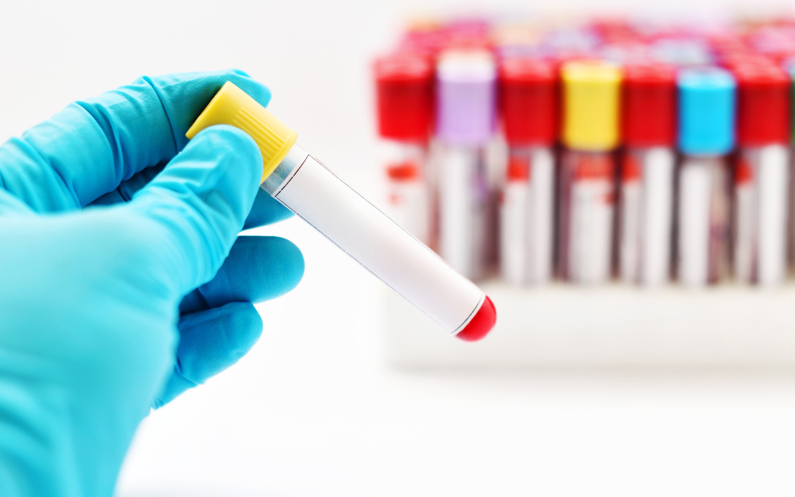 Lipoprotein(a) and the New Cholesterol Test You’ve Probably Never Heard About
