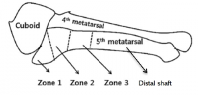 Conditions Fifth Metatarsal Fractures — Adrian Talia