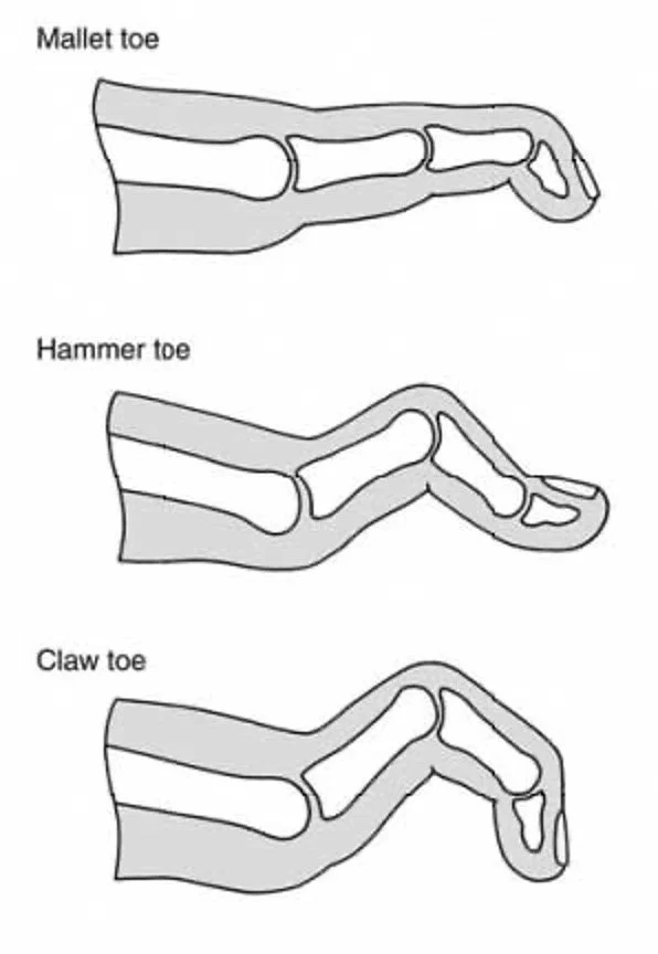 Wedge Toe Defect Conditions Lesser Toe Deformity — Adrian Talia