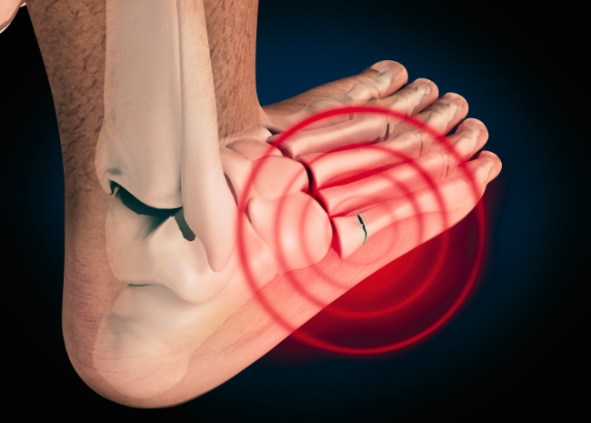 Base of 5th Metatarsal Fractures: What You Need to Know