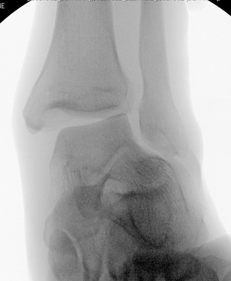 Repairing the Deltoid Ligament in Ankle Fractures: A Shift Towards Faster, More Stable Recovery