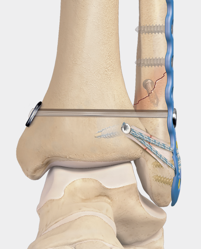 MRI Reports Miss Up to Half of All Syndesmosis Injuries: What Our New Research Shows