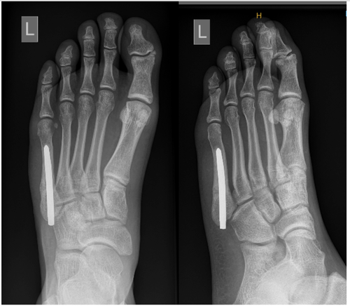 Dy Rods Base of 5th Metatarsal Fracture Treatment Melbourne | Mr Adrian Talia ...