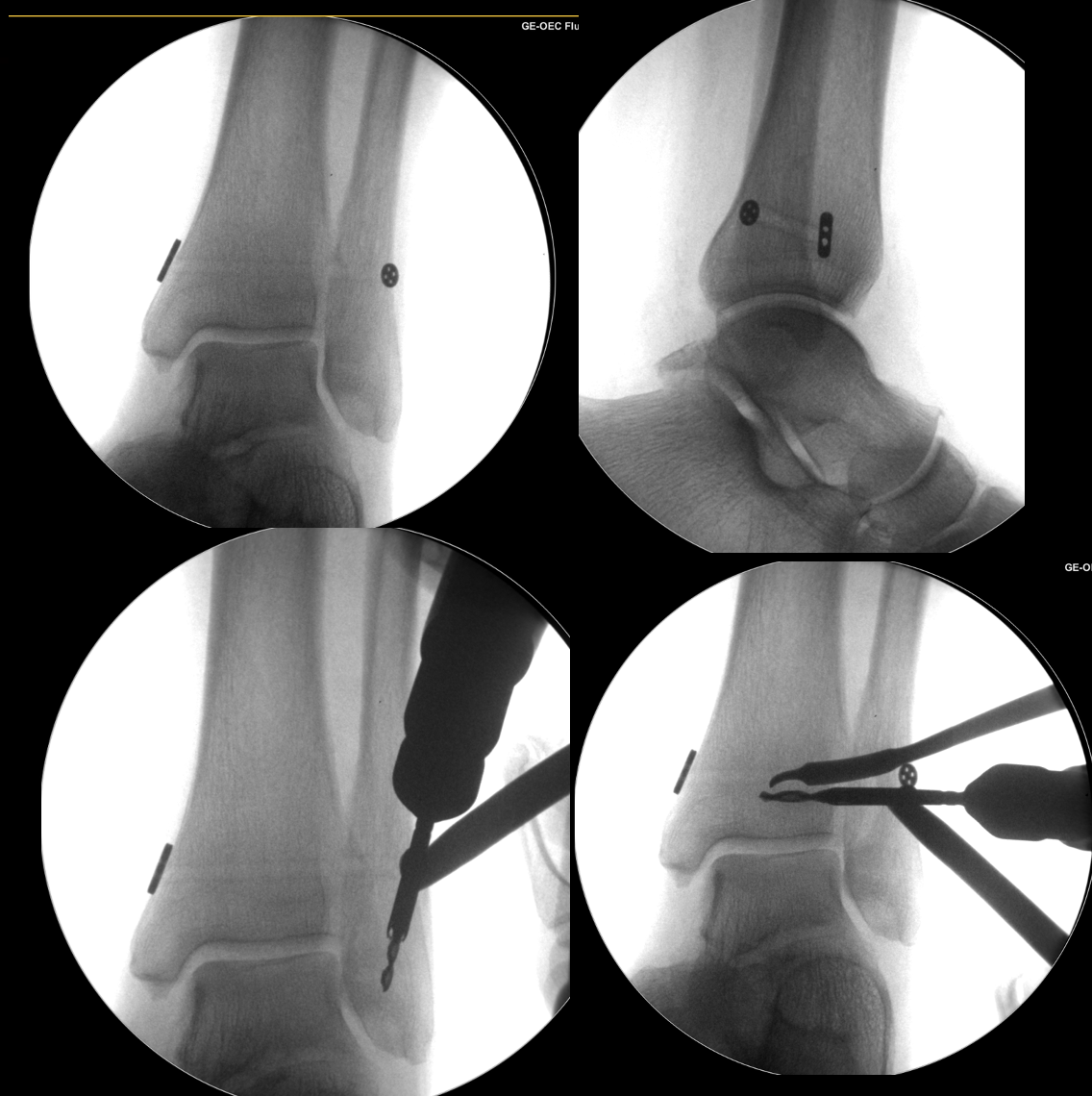 syndesmosis reconstruction surgery