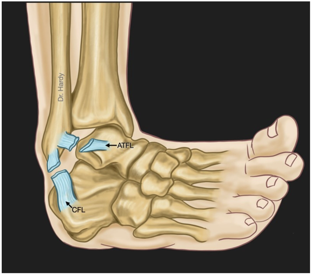ATFL and CFL are the ligaments most commonly ruptured during a traditional "ankle sprain"