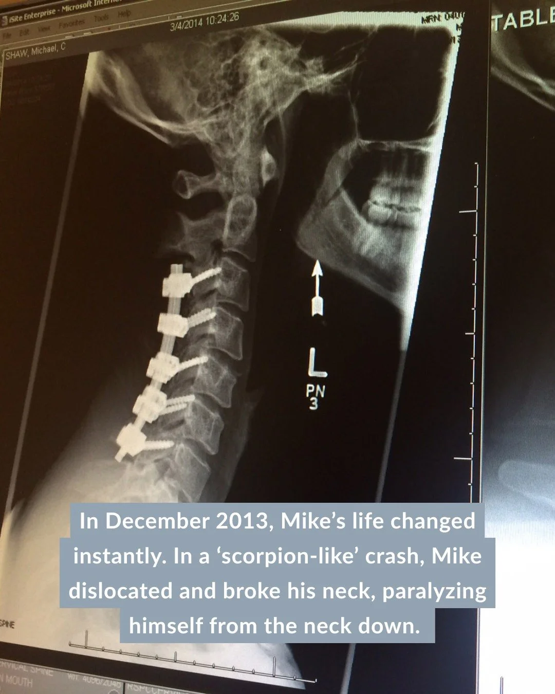 After my injury, I quickly learned recovery wasn&rsquo;t just about muscles, bones, or pain management. It was about mindset. Therapy helped me heal mentally, and that&rsquo;s what gave my body permission to start healing too. 

If you&rsquo;re on a 