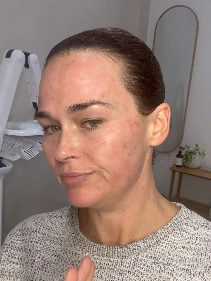 Update for Pico. These two slides at on the same day, directly after 

Slide 1 is just after treating, with residual numbness helping against redness flushing and feeling of heat. 

Slide 2 is the afternoon of treatment. Spots are starting to pop, bu
