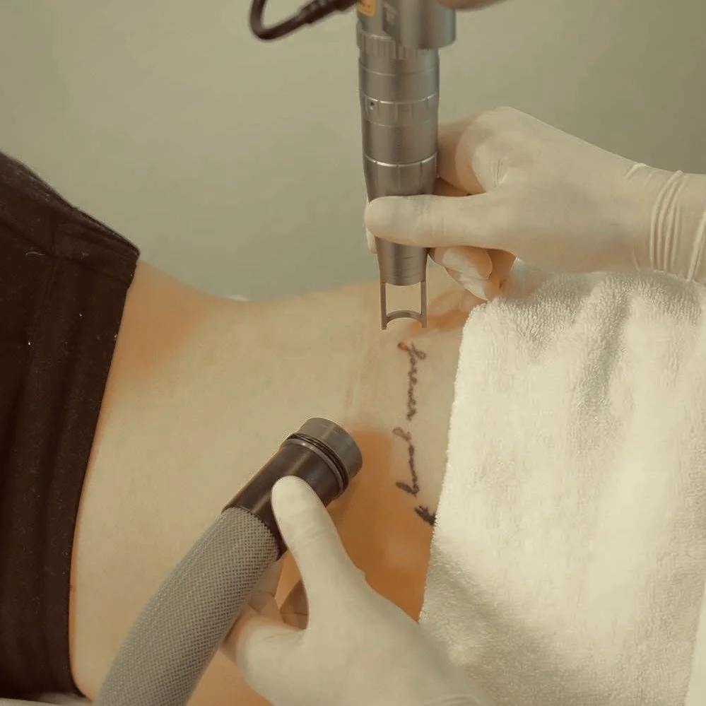 Laser tattoo removal on an arm with a treatment handpiece and cooling nozzle
