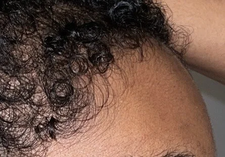 After 1 Year of Using Ree Oil