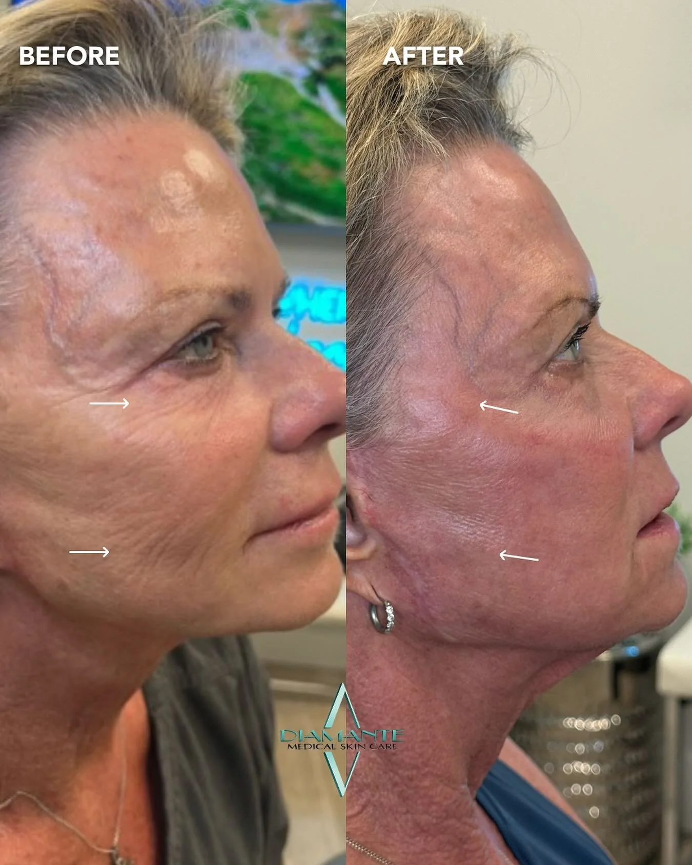 Beautiful UltraClear transformation for our patient ✨UltraClear isn&rsquo;t a one-size-fits-all treatment. It&rsquo;s versatile settings allow us to fully customize your results. Whether your goal is to smooth texture, refine blemishes, or tighten an