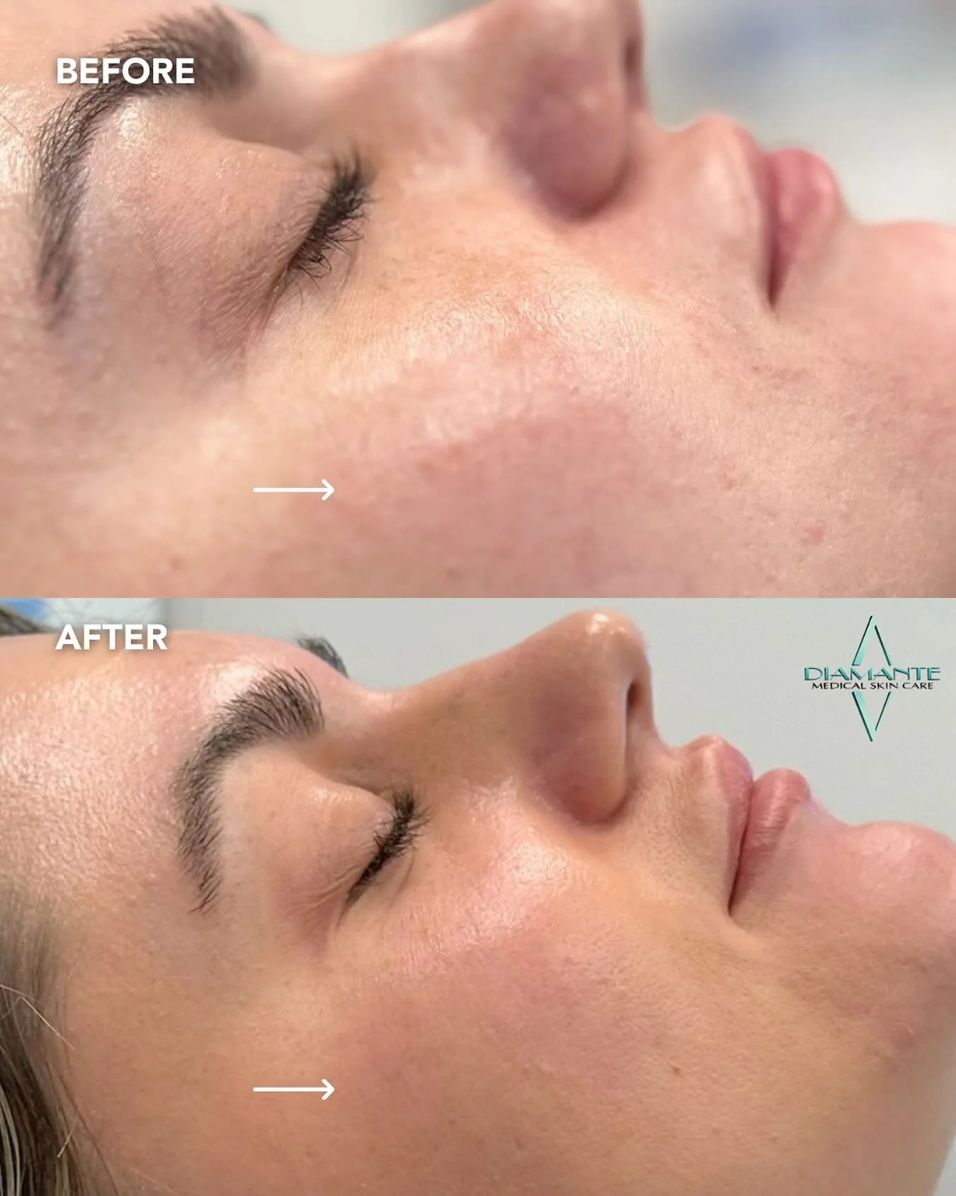 The results speak for themselves 💎 This UltraClear treatment evens out skin tone, reduced blemishes, and revealed a smoother, more radiant glow. 🌊 Ready to transform your skin? Your journey to clarity starts here!

Call to book your appointment tod