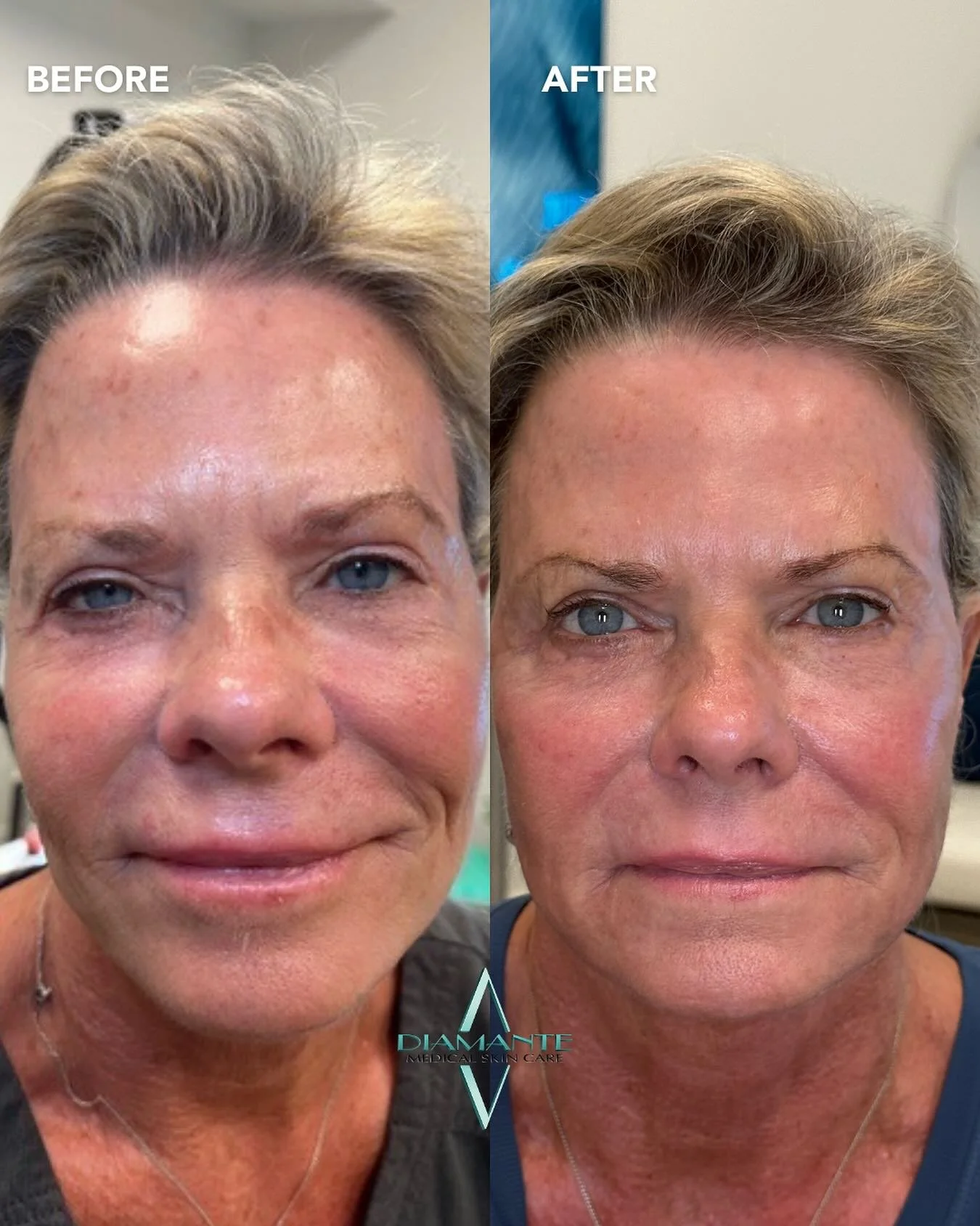 Stunning results for this patient&rsquo;s UltraClear journey ✨ UltraClear works beneath the surface, and after about a week of healing, the skin reveals a smoother texture, more even tone, and refreshed glow. 🧖🏼&zwj;♀️&nbsp;

Call to book your appo