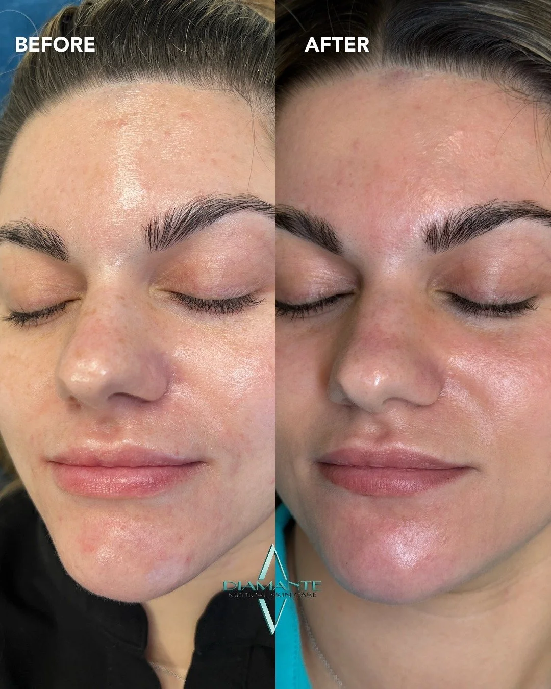 The ultimate reset button for your skin. 💎 UltraClear evens out tone, reduces blemishes, and restores clarity for a fresh, radiant complexion. ✨ Ready to press reset on your skin? Book your UltraClear consultation today! 📲561-270-4478
.
.
.
.
#diam