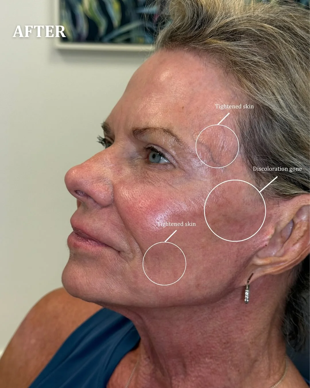Check out these beautiful UltraClear results! Sunspots &amp; brown spots GONE! 😍 This treatment stimulates collagen, helping to tighten and lift the skin while improving overall tone and texture. 🌊

Call to book your appointment today:
📲561-270-44