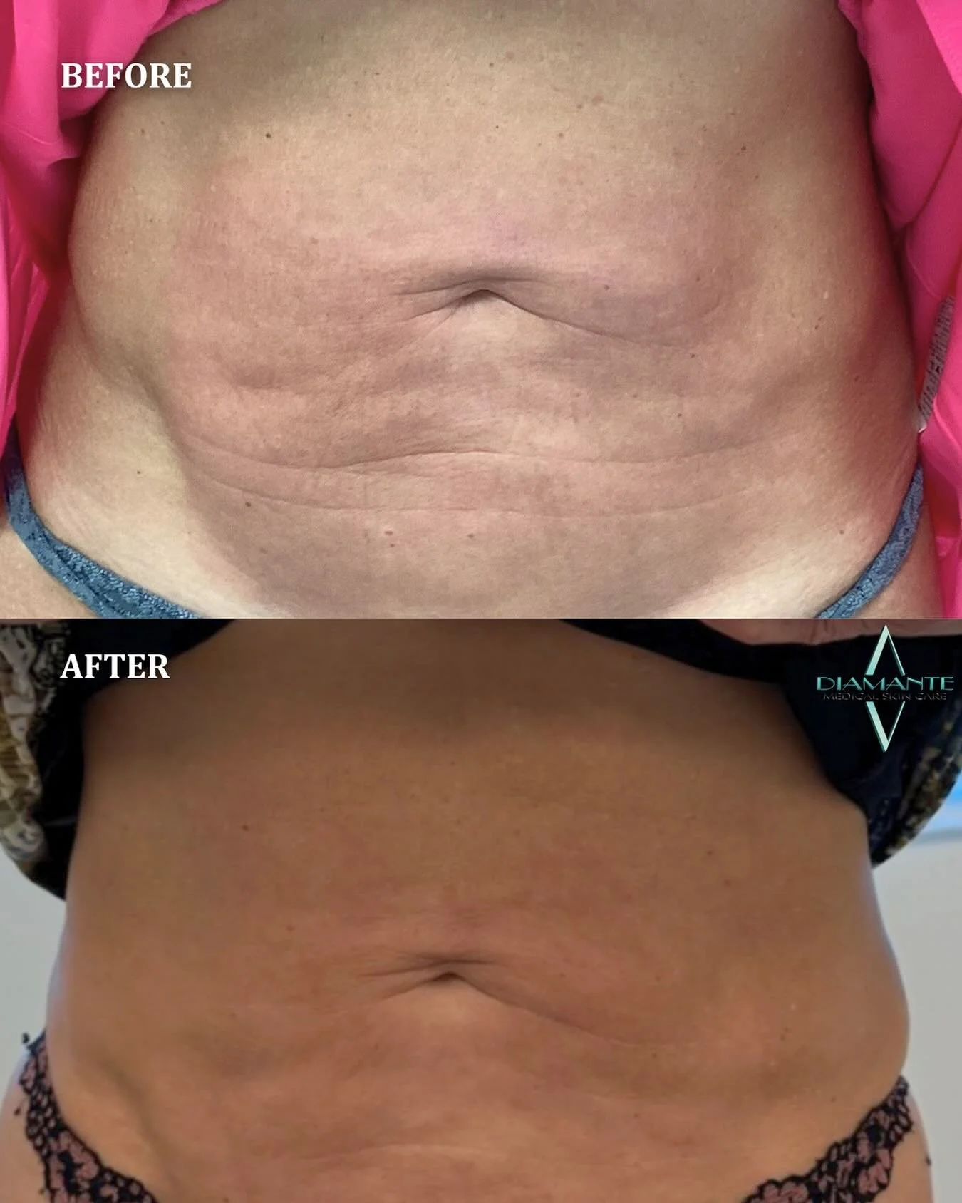 UltraClear isn&rsquo;t just for the face 💎✨ This transformative laser treatment can help tighten, smooth, and rejuvenate skin on multiple areas!

Whether your goal is firmer skin, improved texture, or overall rejuvenation, UltraClear delivers visibl