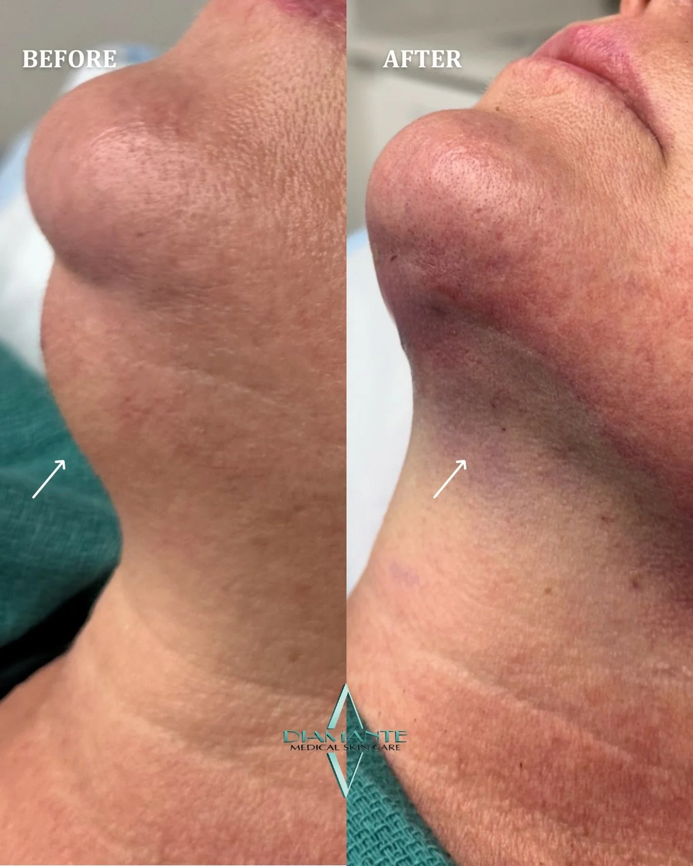 A transformation that speaks for itself. ✨ This treatment combines liposuction for precise fat removal with InstaLift to lift and support the skin, delivering a more defined, youthful appearance!

Interested in learning if this approach is right for 
