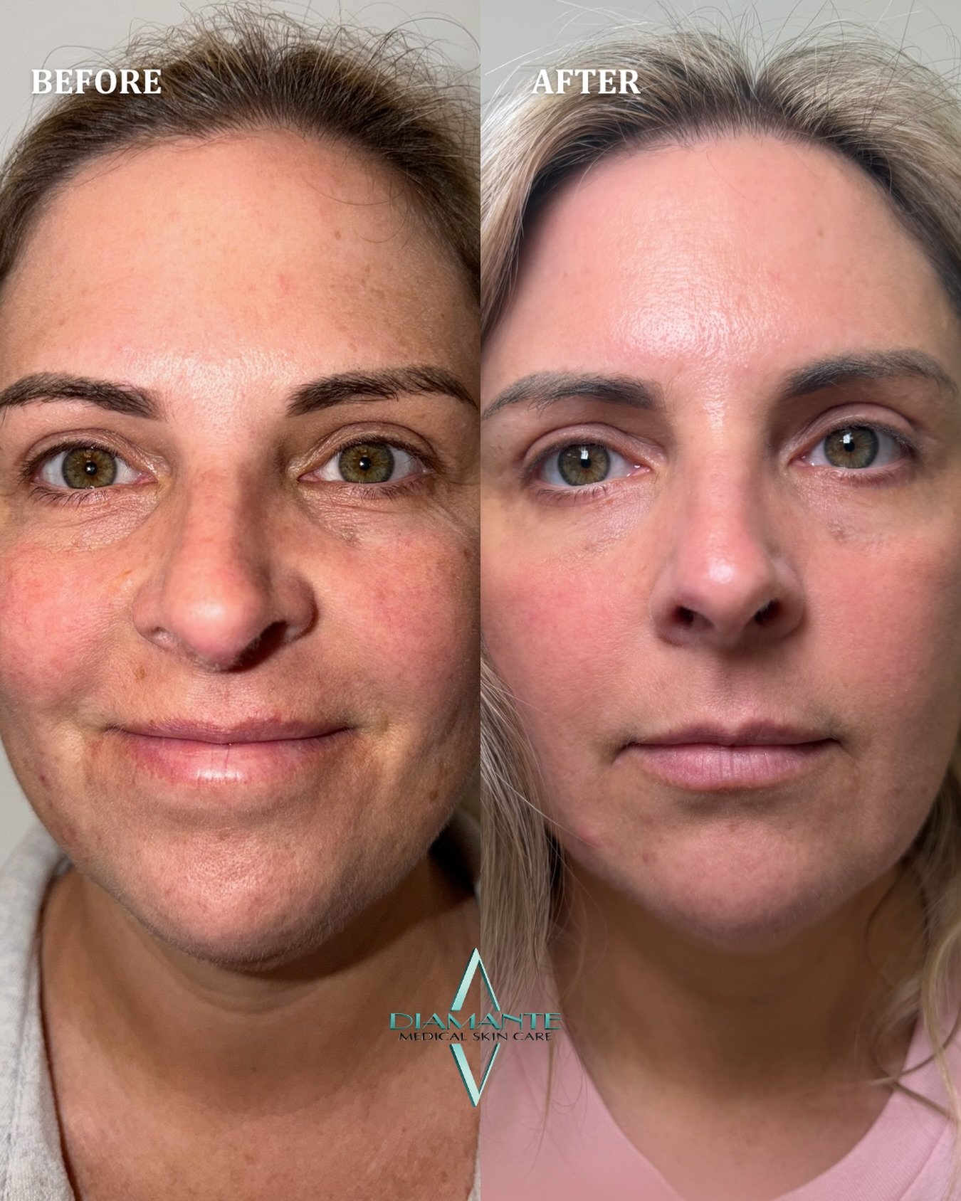 UltraClear Laser delivers next-level skin clarity. ✨ This before &amp; after highlights a major reduction in discoloration and visible spots, revealing smoother, more even-toned skin that looks healthier and refreshed! 🧖🏼&zwj;♀️

Call to book your 