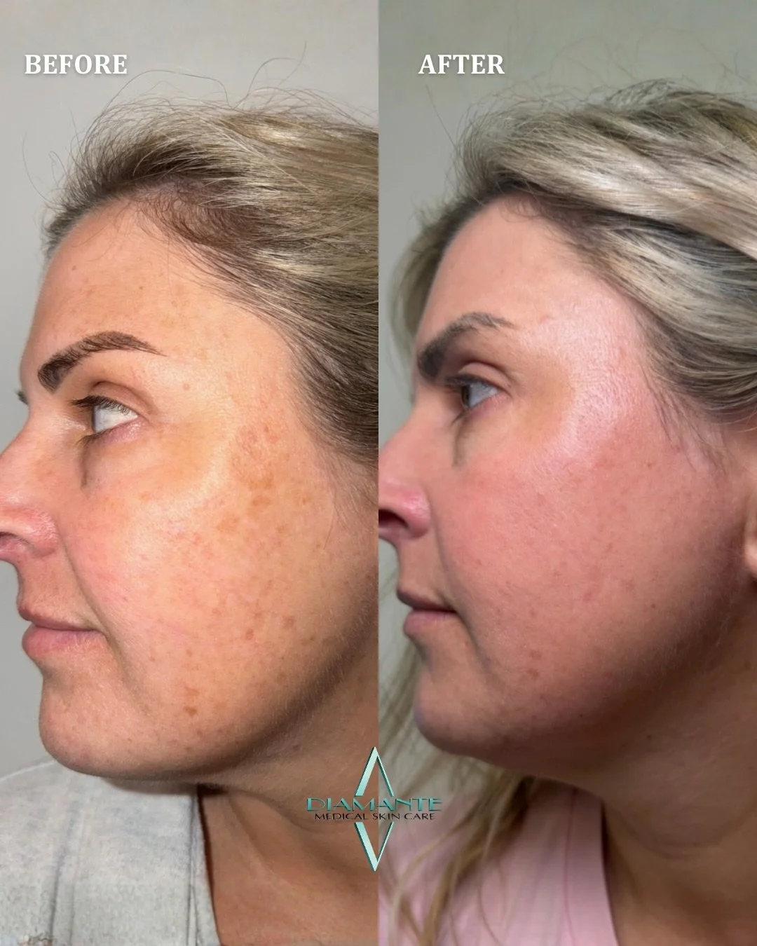 WOW! This UltraClear Laser transformation speaks for itself. These results are after just one treatment✨ UltraClear works deep within the skin to target discoloration and visible spots, revealing smoother, more balanced skin over time. 🫶🏽&nbsp;

Ca