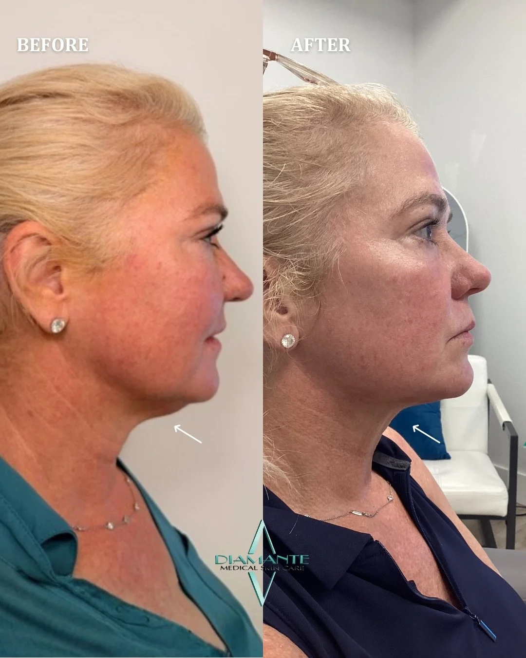 A subtle change with a big impact ✨ This before &amp; after highlights how submental liposuction can beautifully refine the jawline and neck by removing stubborn fat and restoring natural definition! 💎

Call to book your appointment today:
📲561-270