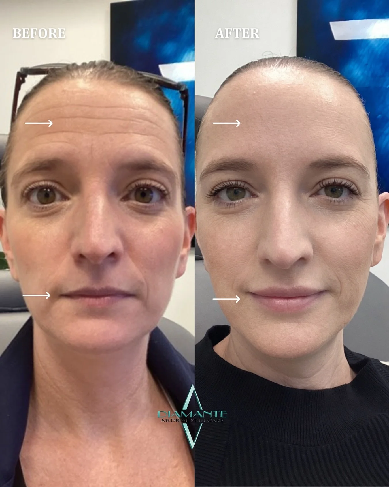 Age reversal in one image... When treatments are layered correctly, everything harmonizes.✨ This beautiful patient came in for Botox and lip filler, a subtle yet beautiful transformation.💉 At Diamante, every treatment plan is customized to the indiv