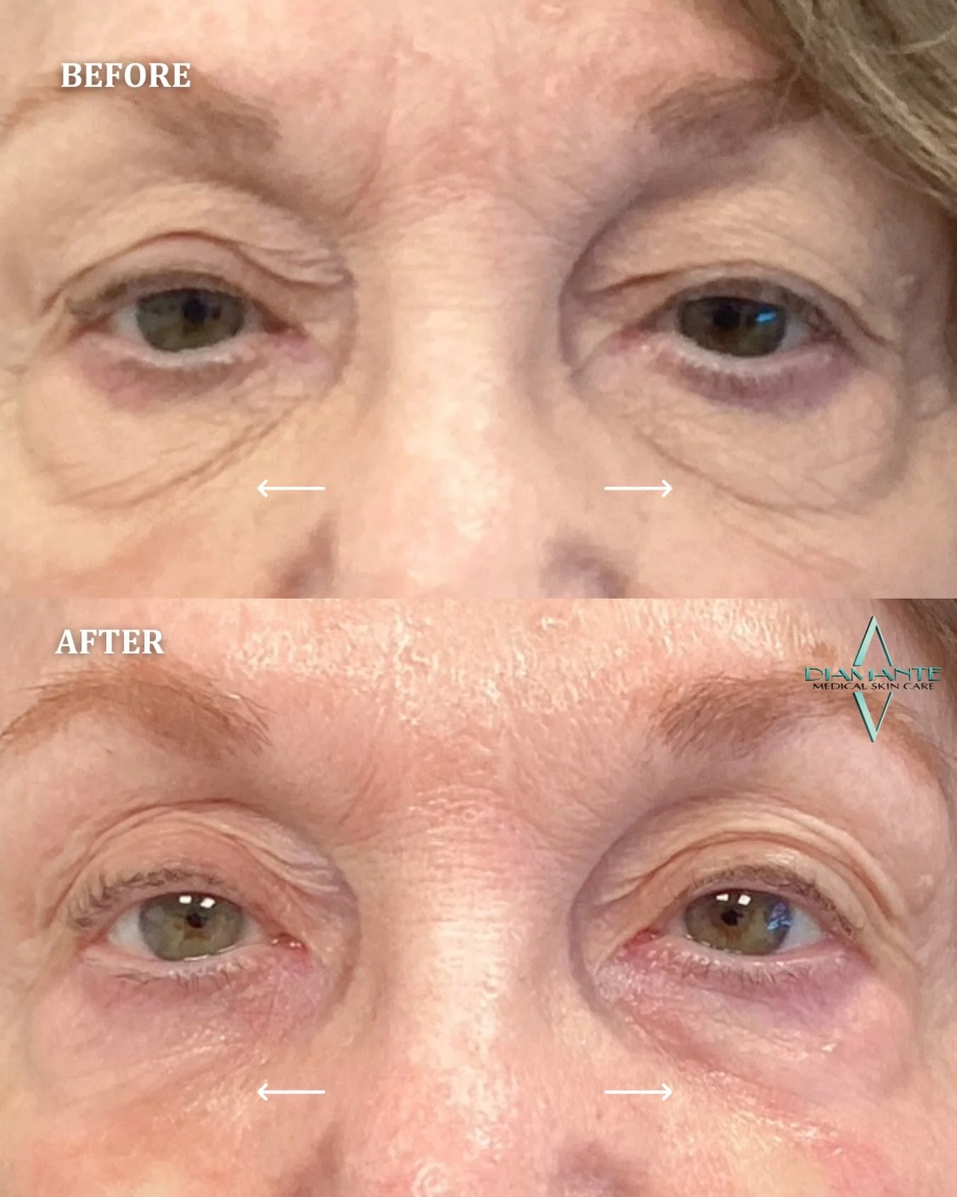 Under-eye filler isn&rsquo;t about changing your face, it&rsquo;s about restoring what&rsquo;s been lost. 💎 Tear trough filler helps soften hollowness, reduce the appearance of dark circles, and create a smoother transition between the lower eyelid 