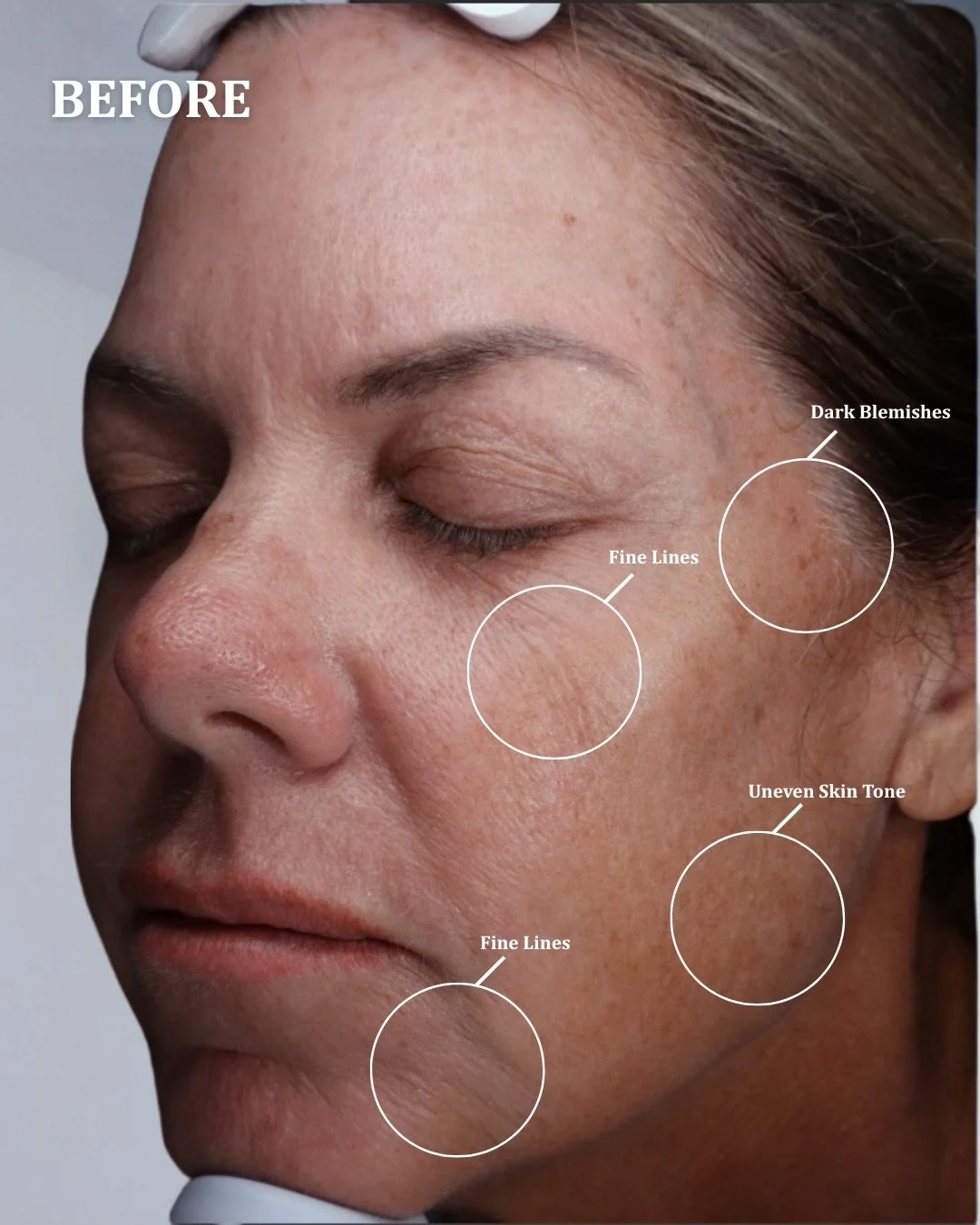 WOW we are obsessed with these results ✨💎

UltraClear is truly a game changer for skin. It helps improve texture, tone, and overall skin quality by stimulating collagen and resurfacing the skin in a way that delivers real, visible change. We cannot 