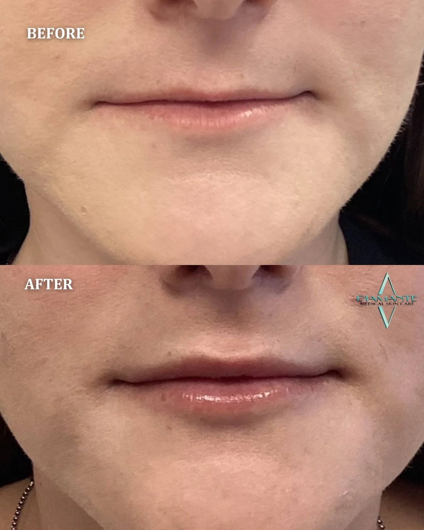 It&rsquo;s often the smallest details that make the greatest impact. 💋

This approach to lip filler focuses on soft definition and subtle volume creating results that feel balanced, refined, and effortlessly natural.

Comment LIPS below and we&rsquo
