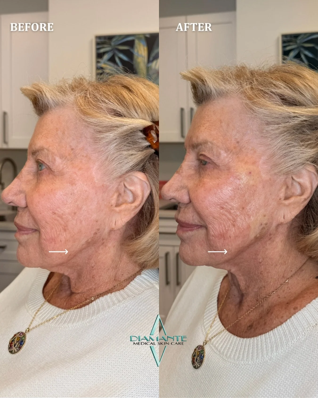 A more refined approach to lifting and restoring. ✨PDO threads are designed to gently lift and tighten while stimulating your body&rsquo;s natural collagen over time&mdash;improving skin laxity, enhancing definition, and restoring a more refreshed ap