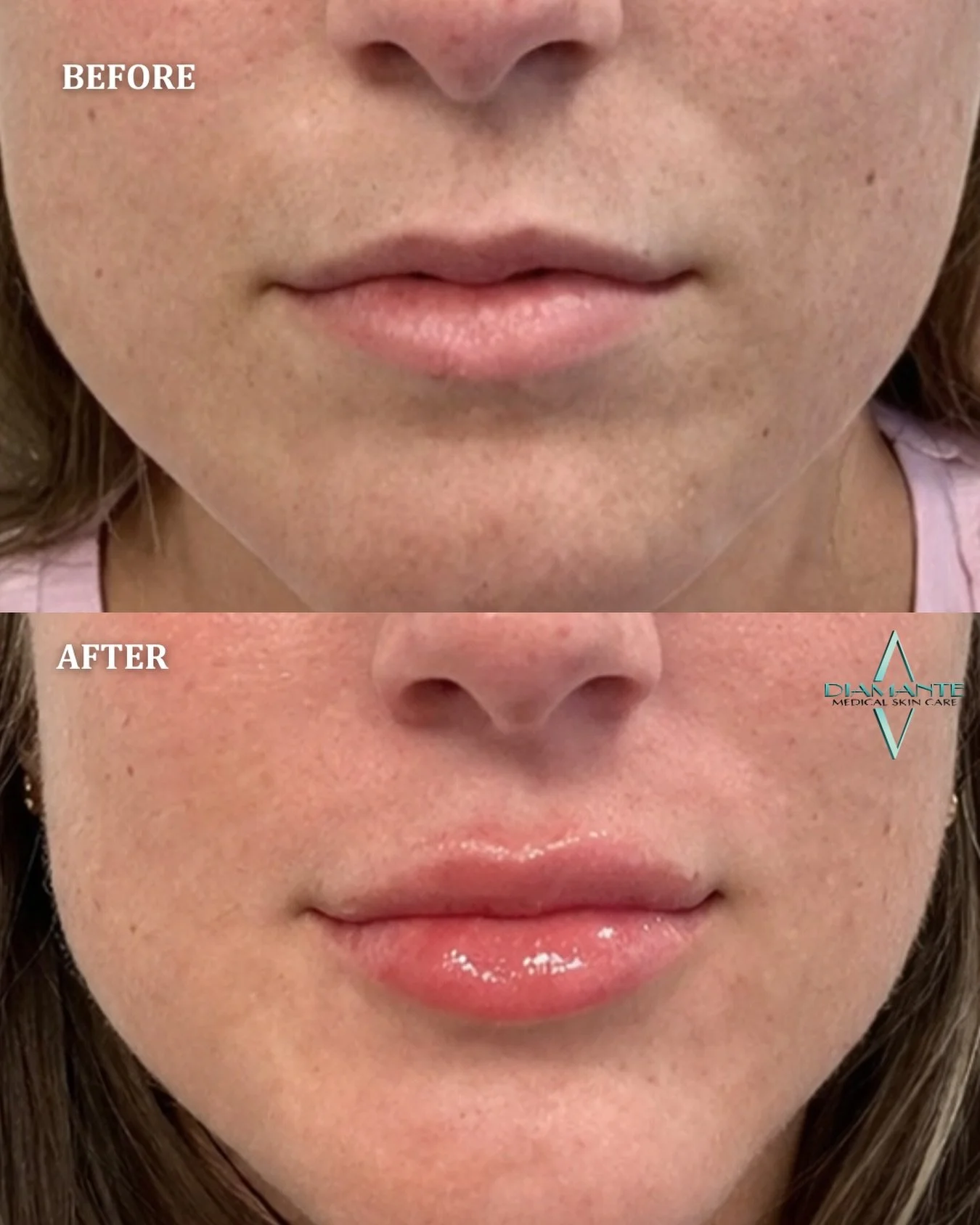 We love results like these. 💋 At Diamante, every treatment begins with understanding your vision so your results feel like you, just thoughtfully enhanced. We used Versa here for her lips to create soft, natural-looking volume with beautiful shape a