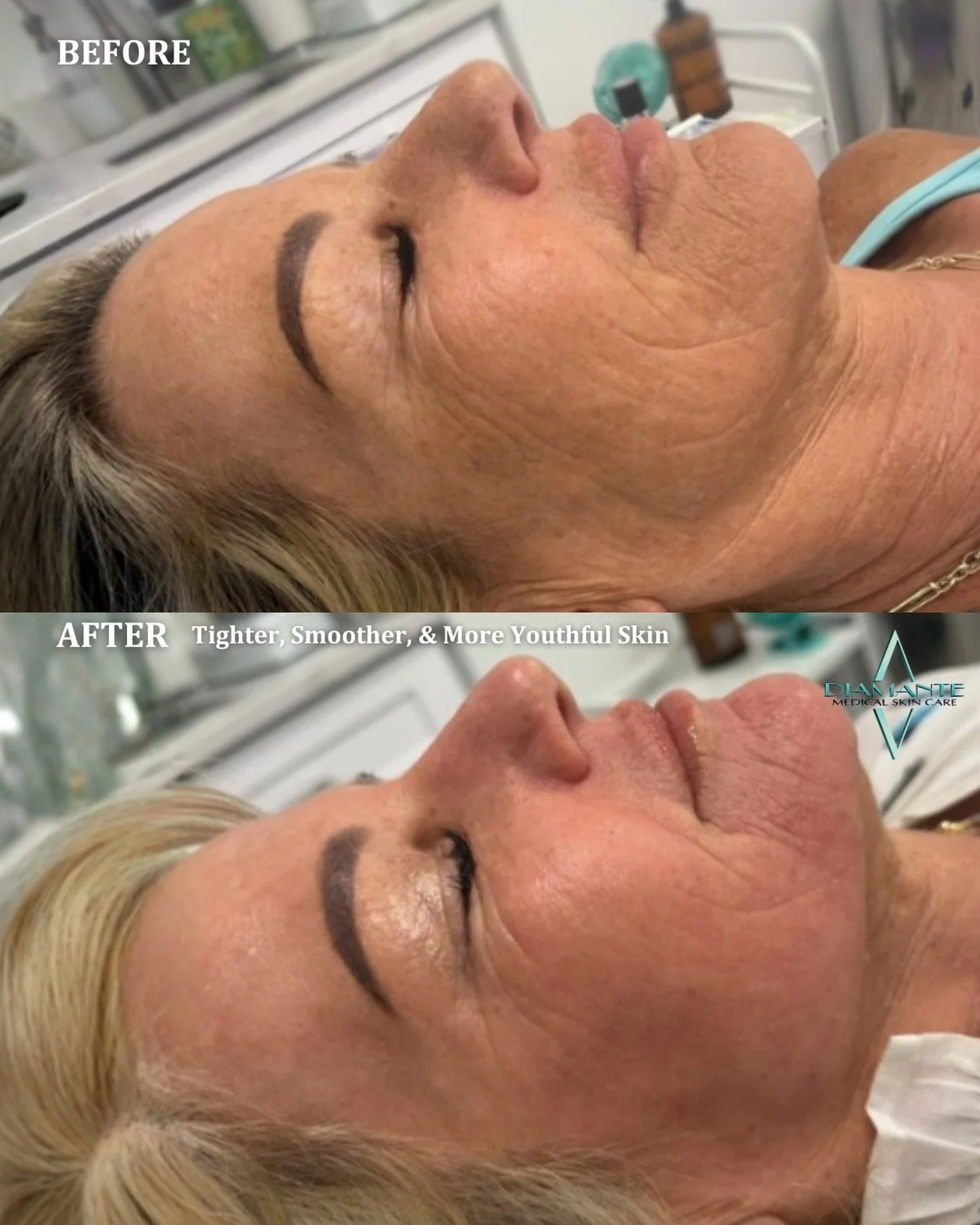 This is your sign to stop settling for surface-level results ❌ UltraClear works deep within the skin to stimulate collagen, improve texture, minimize fine lines, and target sun damage! It&rsquo;s truly one of the most advanced ways to truly reset you