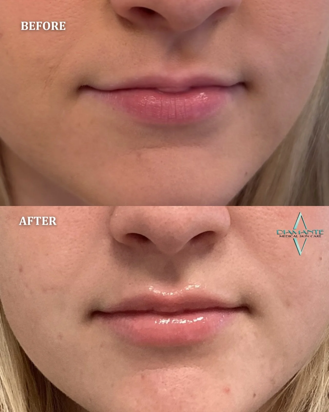 Beautiful, refined results like these. 💋

Natural lip filler is designed to enhance your shape with soft, balanced volume, never overdone. Each treatment is thoughtfully tailored so the result feels effortless and true to you.

Comment LIPS below an