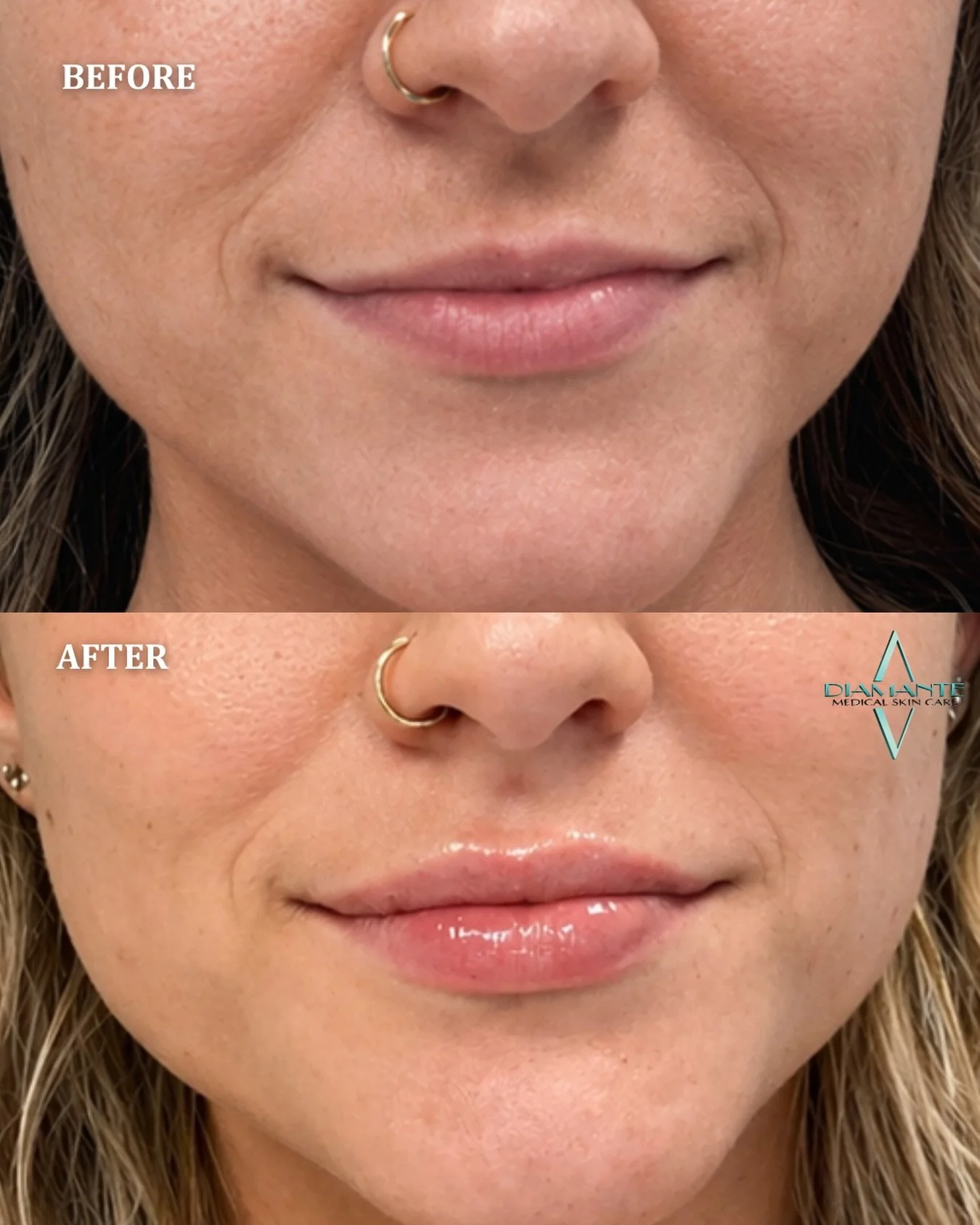 Your lips&hellip; just elevated ✨ 
A little volume, better shape, and that effortless glossed finish

⏰ : 20 minute appointment 
💊 : Bruises and swelling are common 
❌ : Avoid Alcohol and fish oil at least 48 hours before 
👄 : Pictures taken before
