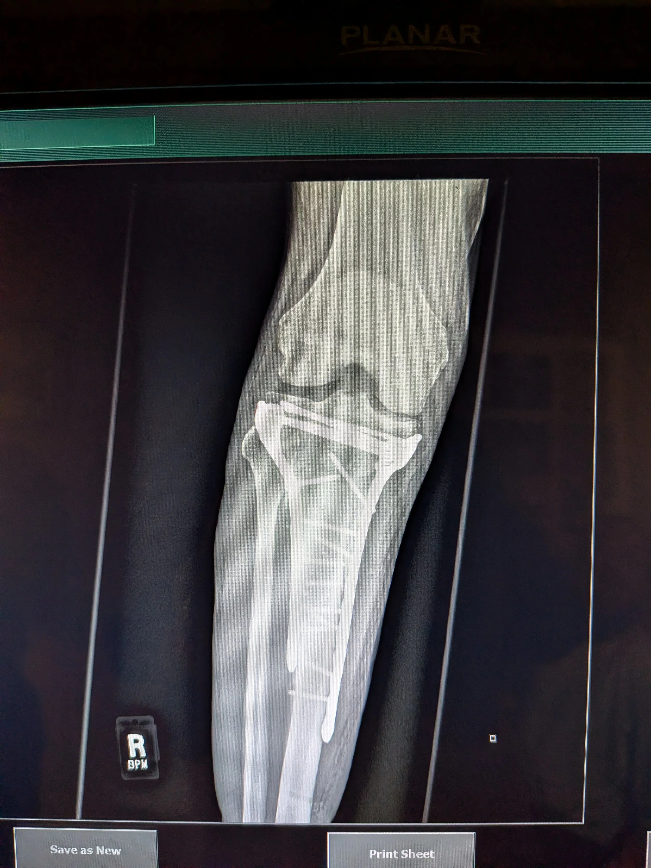 Right Leg