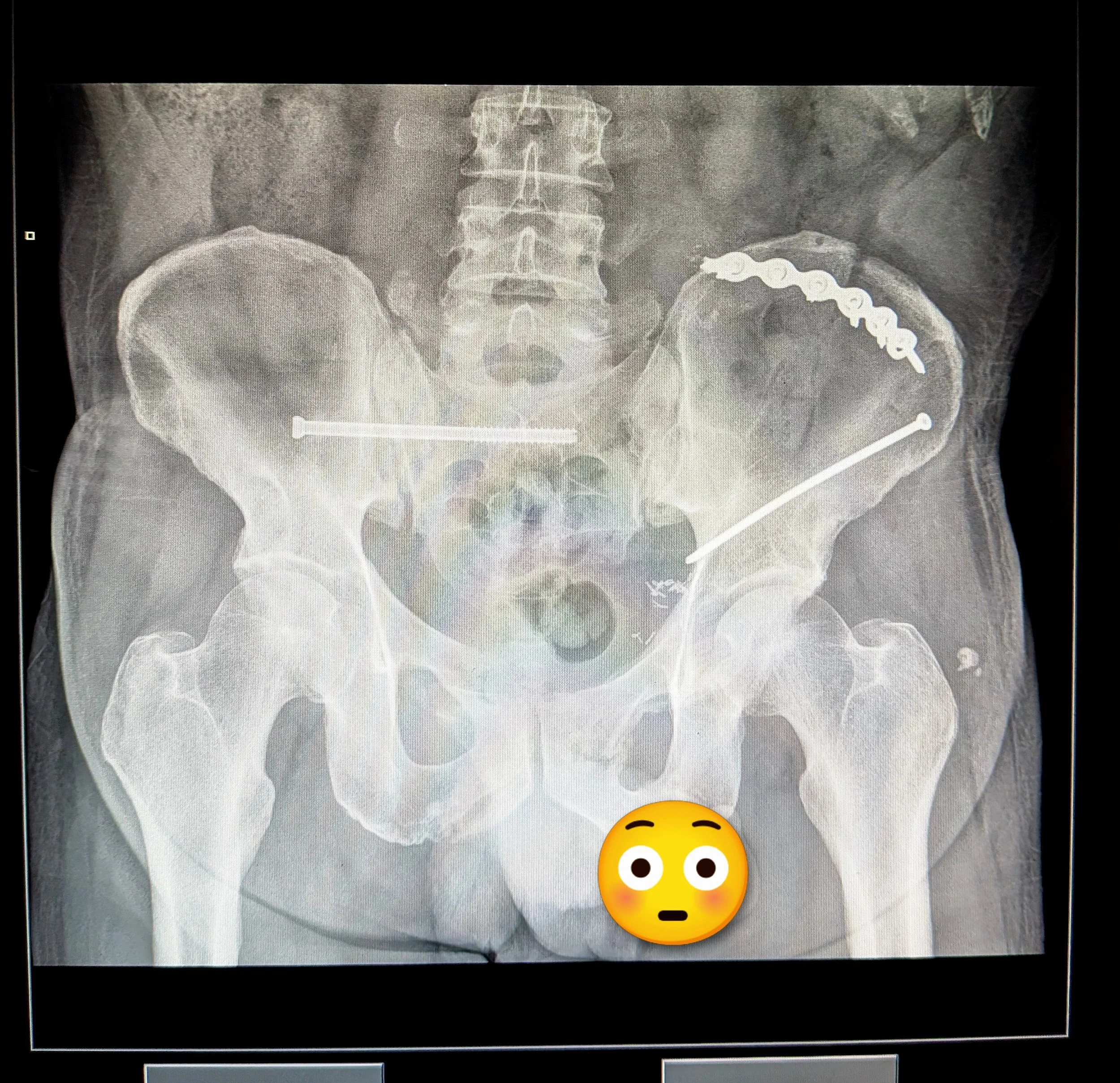 Pelvis