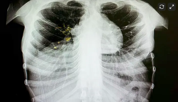 Chest X-ray showing lungs with possible infection or blockage, especially in the left lung.